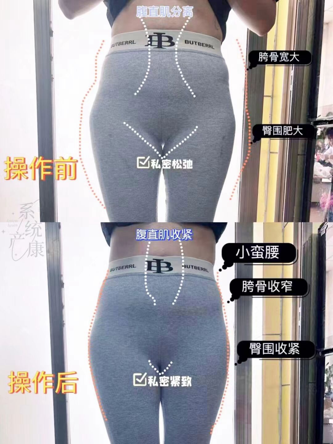 产后肚皮细纹明显严重怎么办？修复产后肚子方法助力！